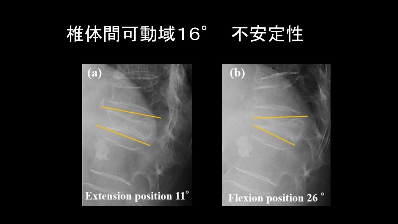 BKPで対応できない骨粗鬆症性椎体骨折とは? | 成尾整形外科病院 BKPで対応できない骨粗鬆症性椎体骨折とは? | 成尾整形外科病院